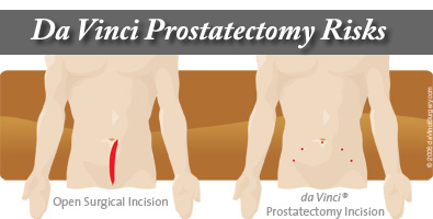 Da Vinci Robot Prostatectomy Risks