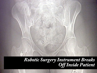 Da Vinci Robot Instrument Breaks Off Inside Patient